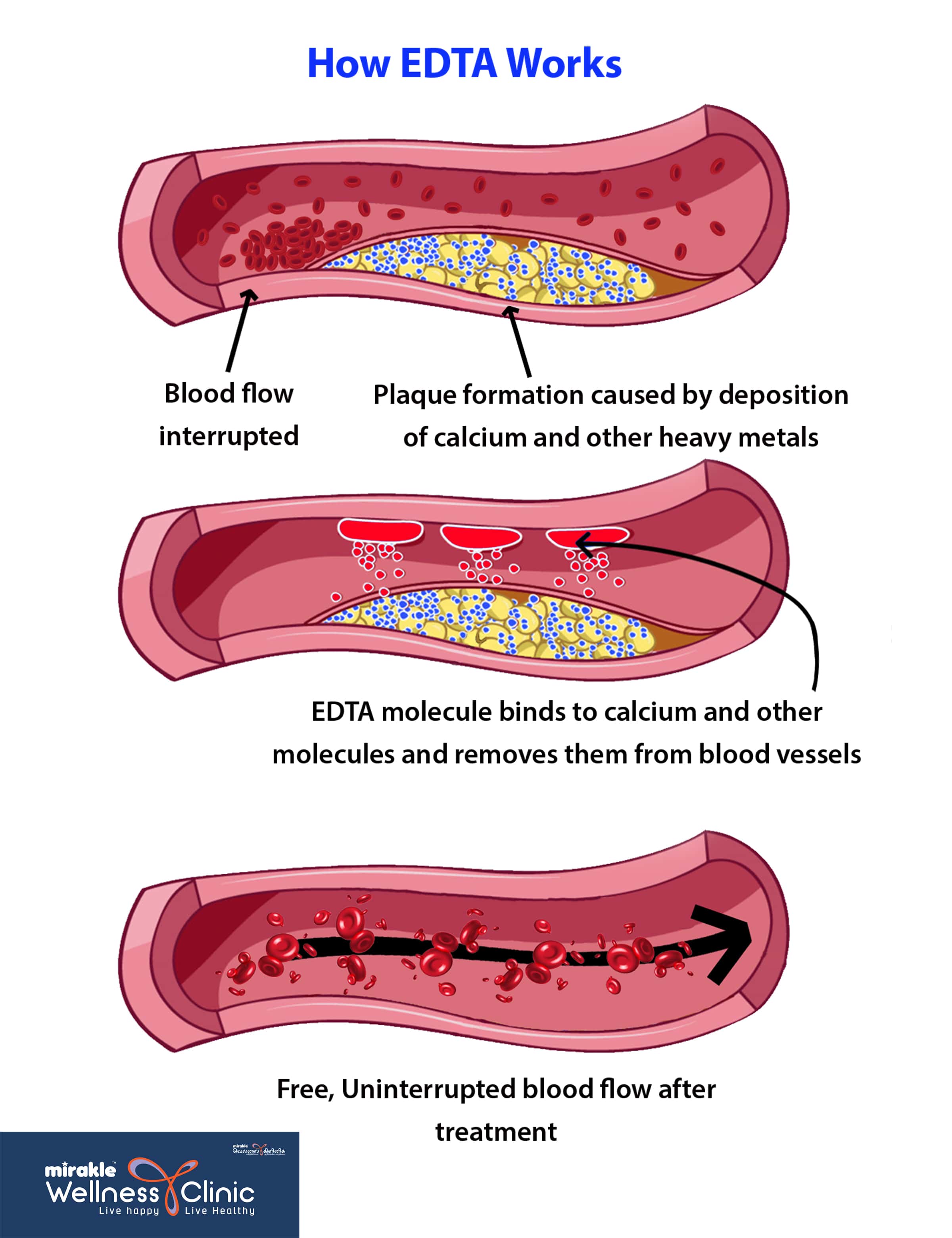How ECP Therapy Works