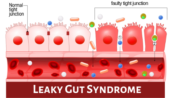 Leaky gut Syndrome